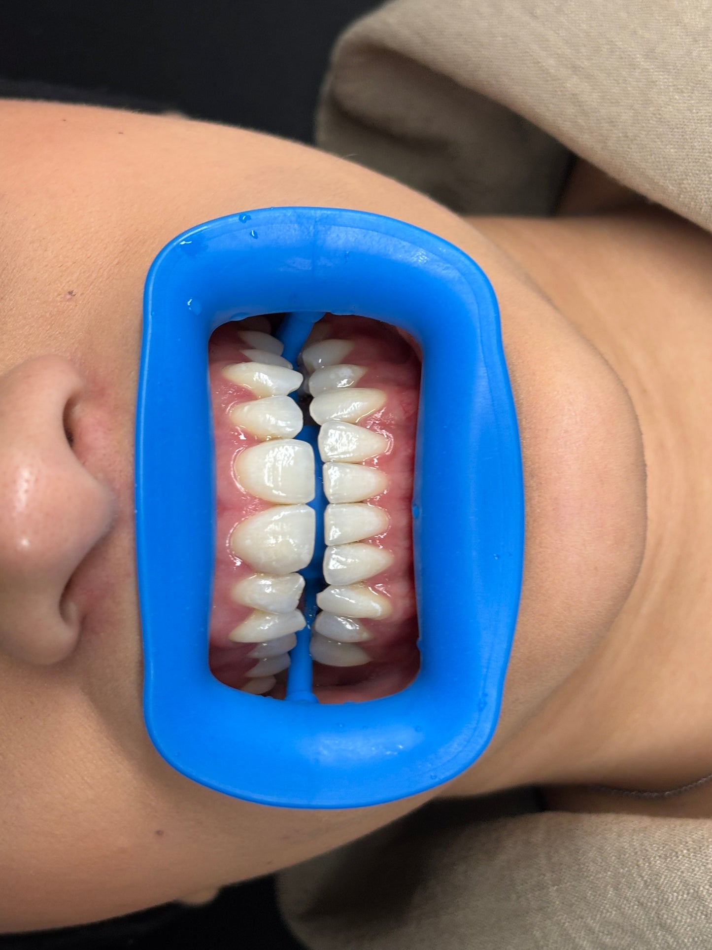 Modèle portant un écarteur buccal bleu pour séance de blanchiment dentaire, dents bien visibles sur fond neutre.