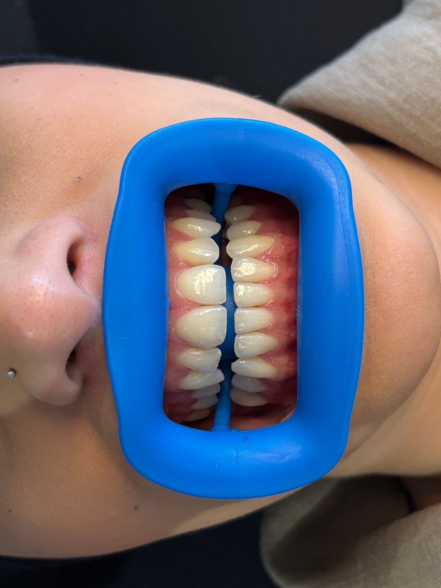 Modèle portant un écarteur buccal bleu pour séance de blanchiment dentaire, dents bien visibles sur fond neutre.